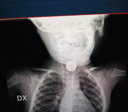 radiografia pila incastrata